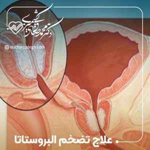 علاج تضخم البروستاتا