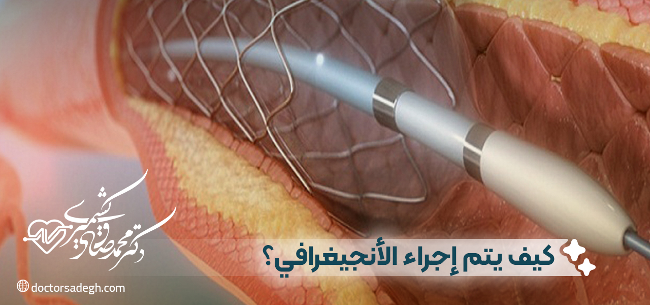 كيف يتم إجراء الأنجيغرافي؟