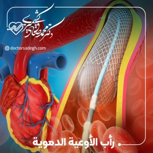 رأب الأوعية الدموية