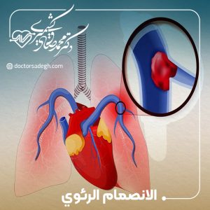 الانصمام الرئوي