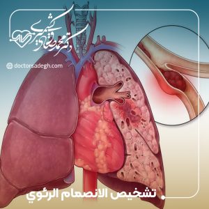 تشخيص الانصمام الرئوي