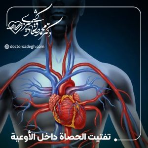 تفتيت الحصاة داخل الأوعية (IVL)