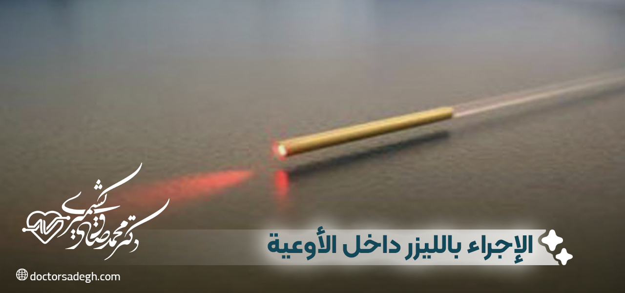 مراحل الإجراء بالليزر داخل الأوعية