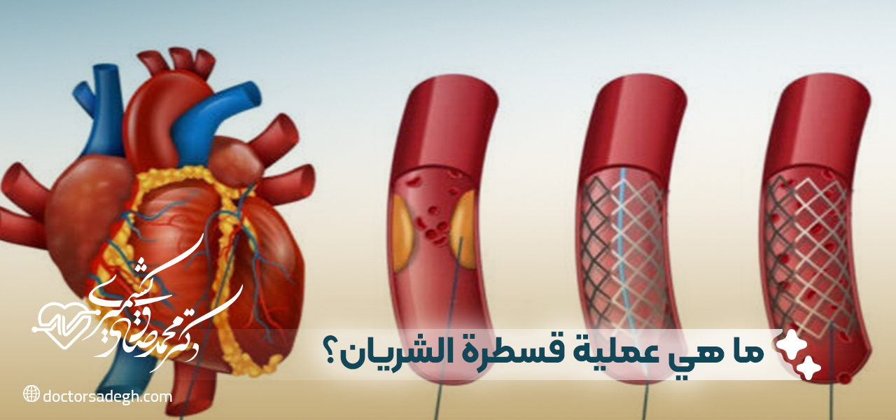ما هي عملية قسطرة الشريان؟
