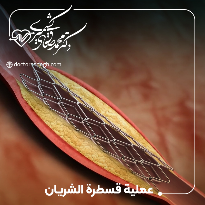 عملية قسطرة الشريان